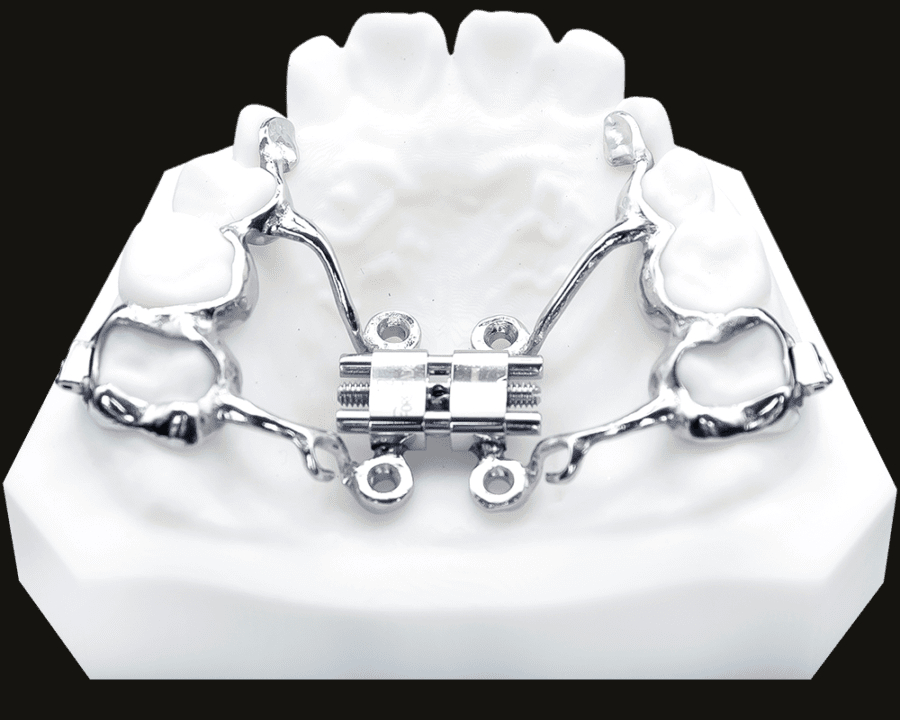 MSE / MARPE expansion appliance on stone model