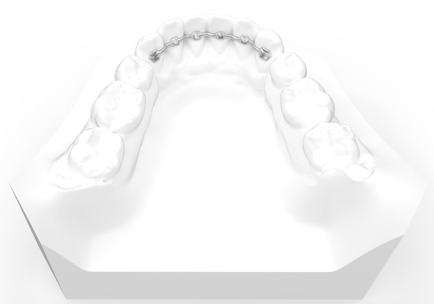 Lingual Retainer